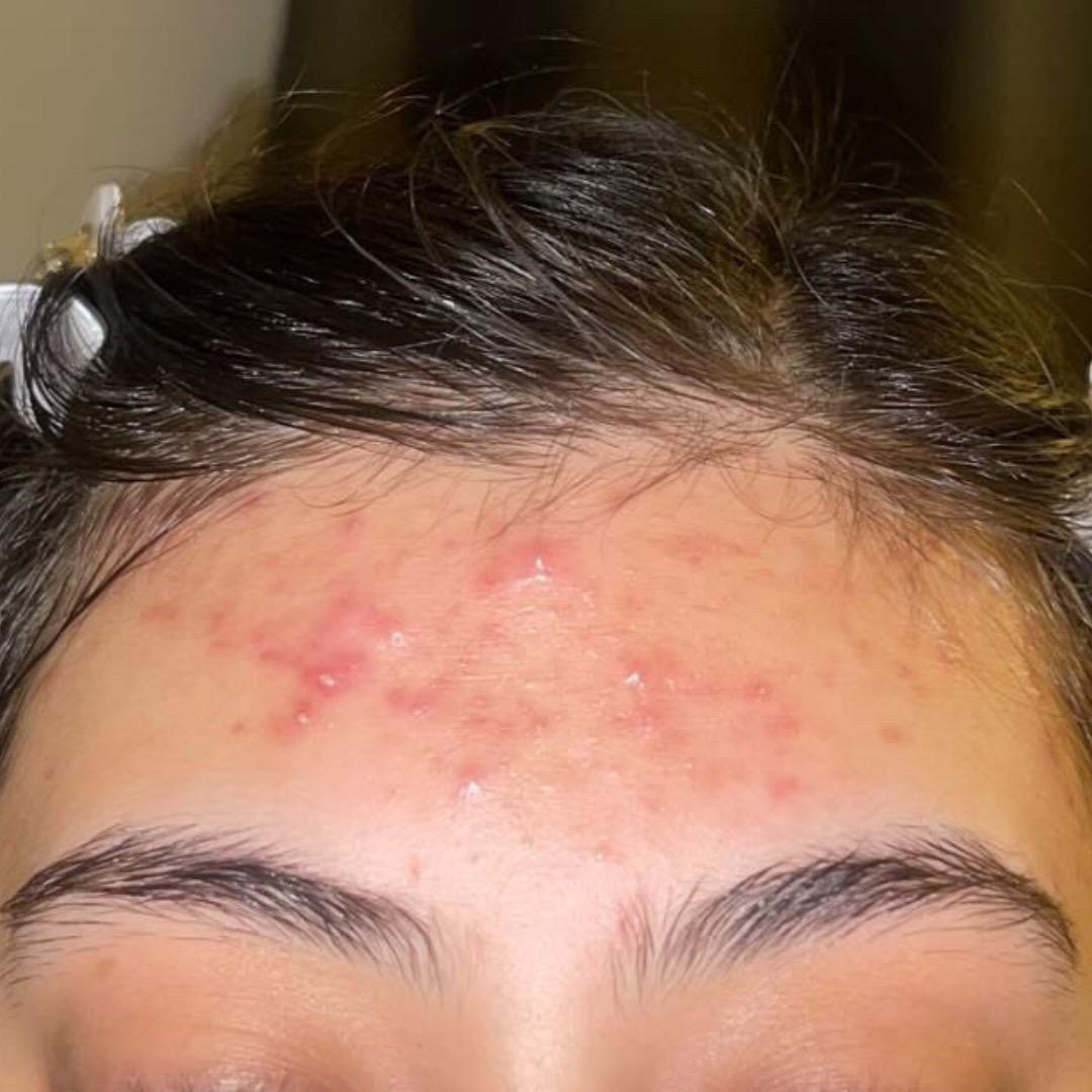 Before treatment at Faded Skin®