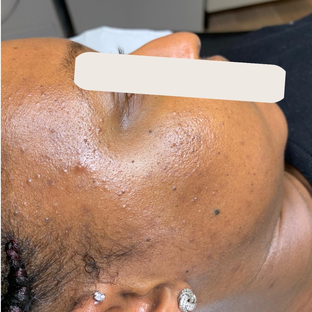 Before treatment at Faded Skin®