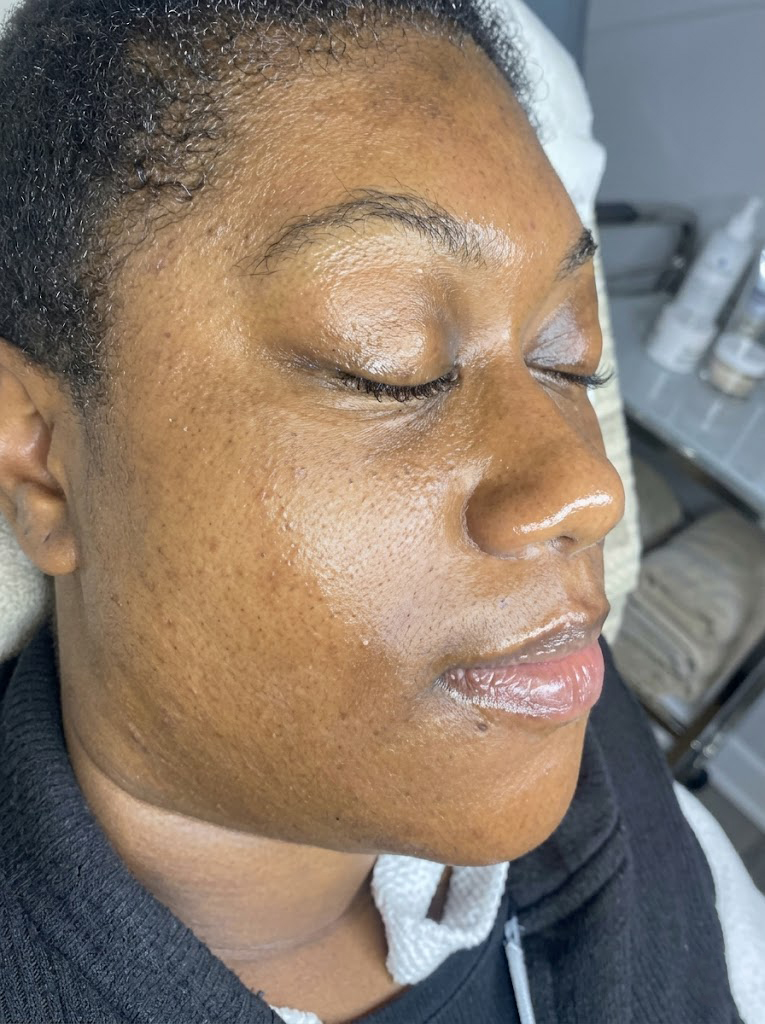 Texture treatment result at Faded Skin®