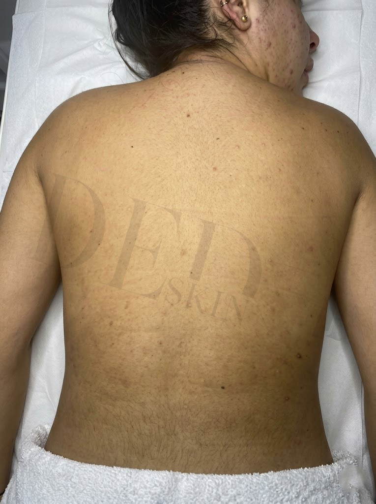 Hyperpigmentation treatment result at Faded Skin®