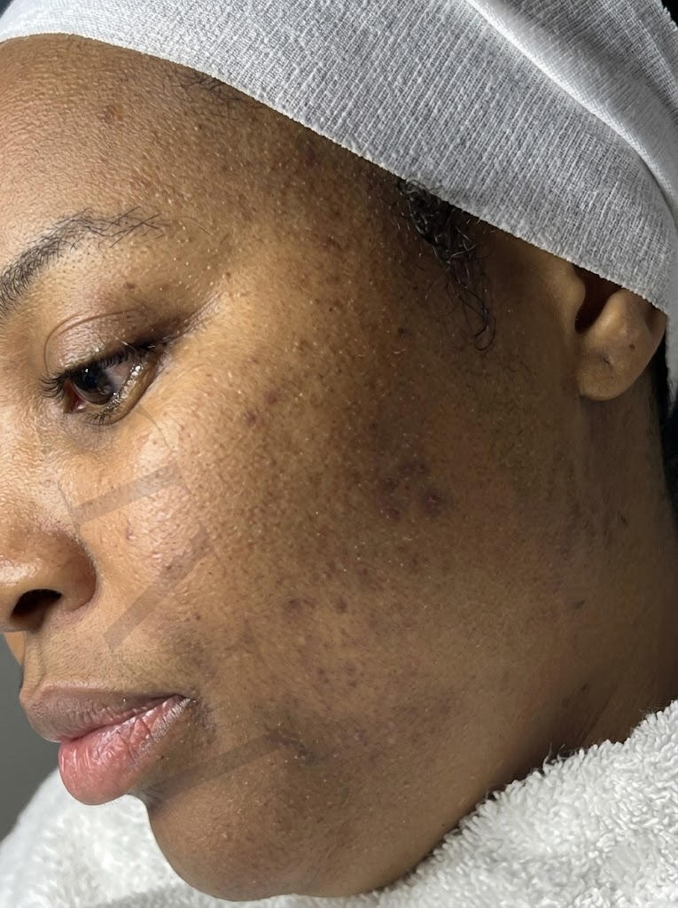 Scarring treatment result at Faded Skin®