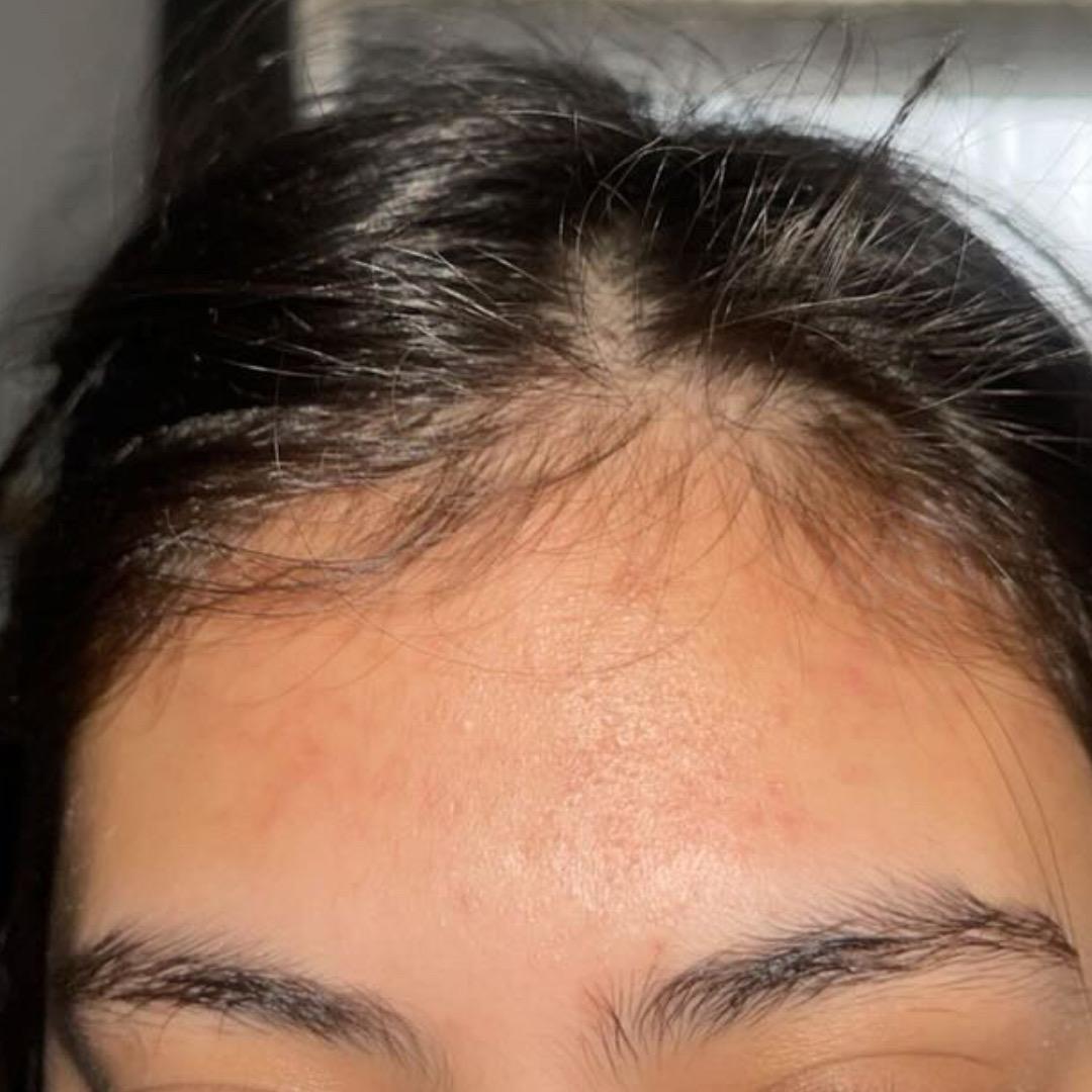 After treatment at Faded Skin®