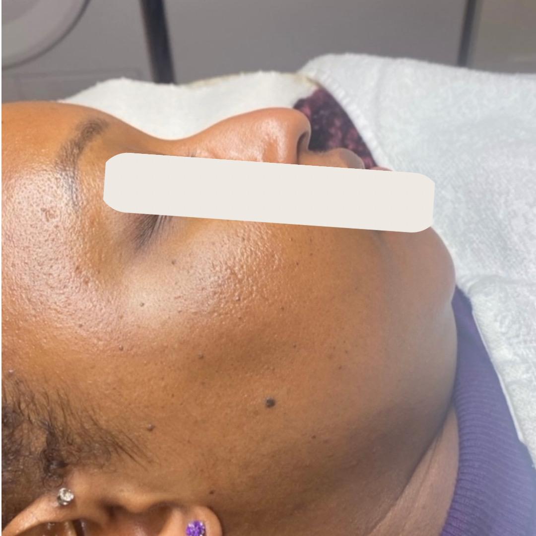After treatment at Faded Skin®