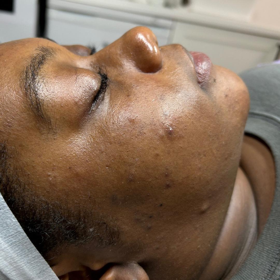 Before treatment at Faded Skin®