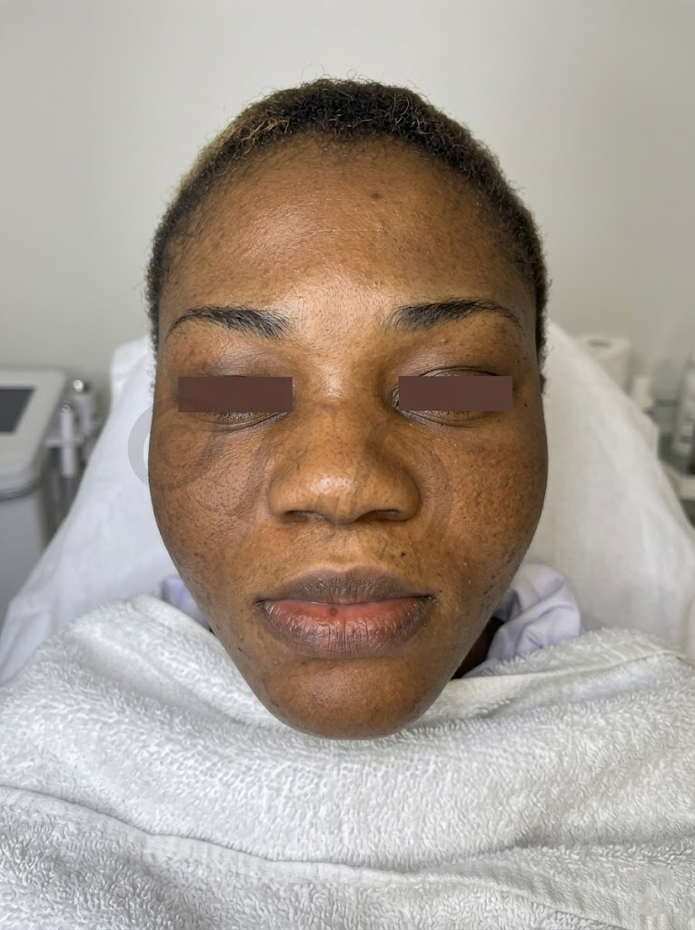 Acne treatment result at Faded Skin®